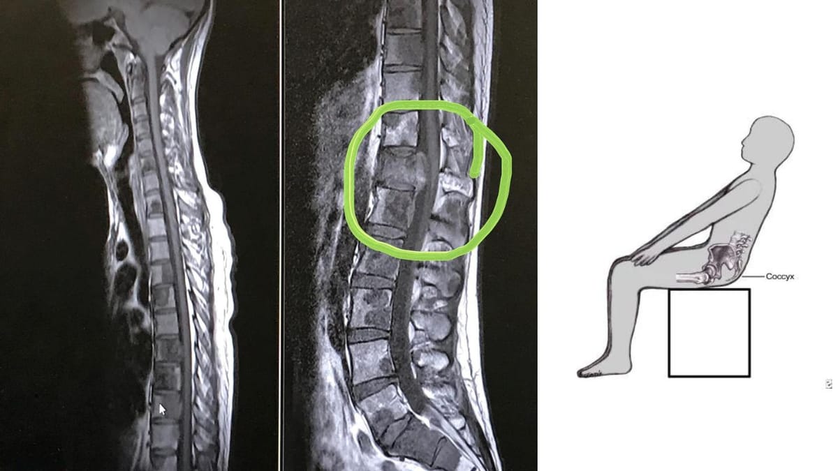 Can Coccyx Pain Be Cancer? An Informative Guide