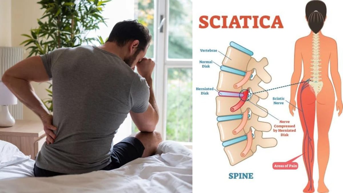 Signs of Sciatica Improving - Key Indicators & Recovery Tips