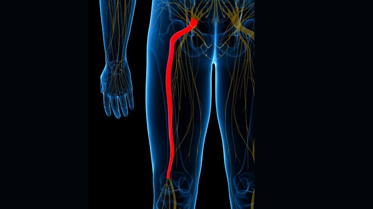 What Is Sciatica? A Guide to Understanding Sciatica Pain