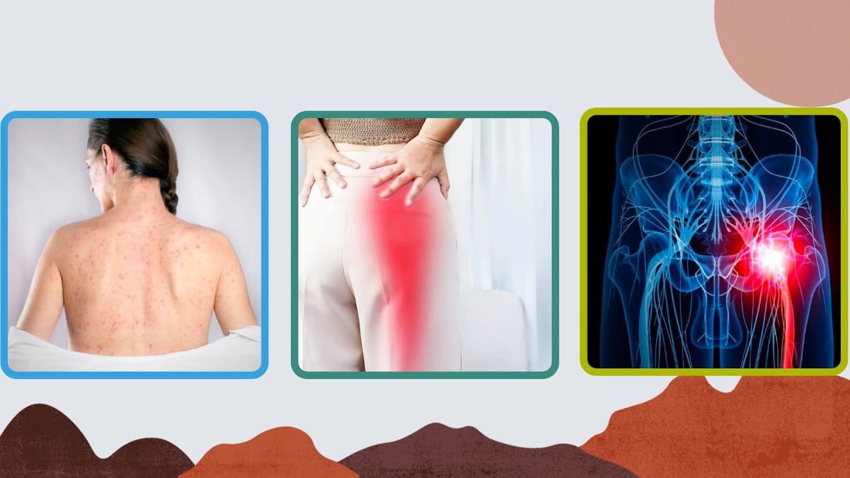 Are Sciatica and Shingles Related? Exploring the Connection