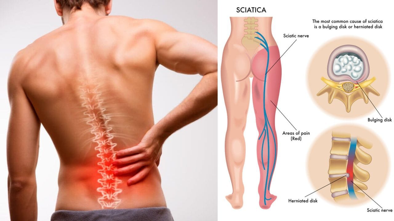 can gabapentin make sciatica worse