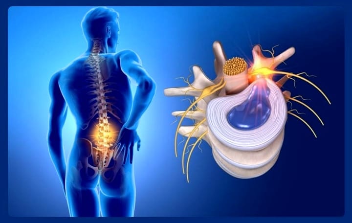 Herniated Disc and Sciatica